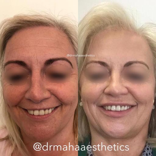 Dr Maha Aesthetics Anti-wrinkle Injections Upper Face