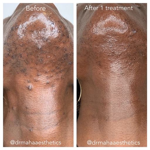 Dr Maha Aesthetics Microneedling Before and After