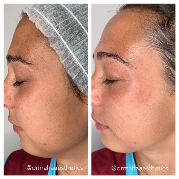 Dr Maha Aesthetics Chemical Peel Before and After