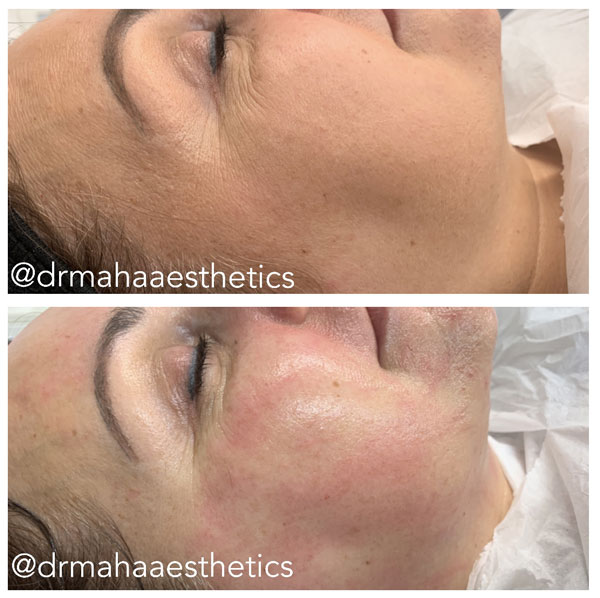 Dr Maha Aesthetics Dermaplaning Before and After