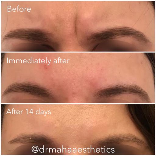 Dr Maha Aesthetics Anti-wrinkle Injections Frown Area
