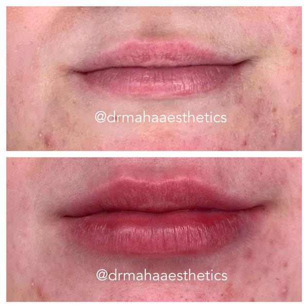 Dr Maha Aesthetics Lip Enhancers