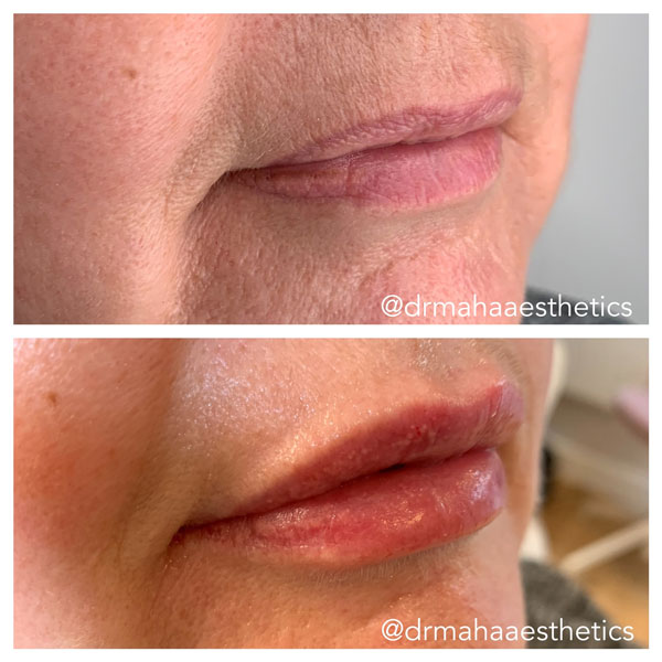 Dr Maha Aesthetics Lip Enhancers
