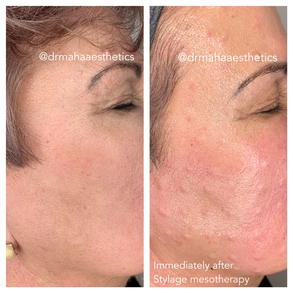 Dr Maha Aesthetics Mesotheraphy Before and after
